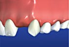 Teeth in need of a dental bridge