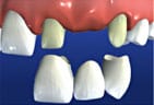 The dental bridge is then cemented on to the prepared teeth