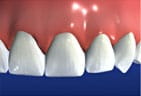 Dental Bridges restore the natural beauty of the teeth