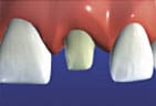 Tooth with surface structure removed in prep for a dental crown
