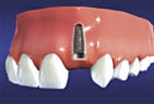 Dental Implant Post is Surgically Placed