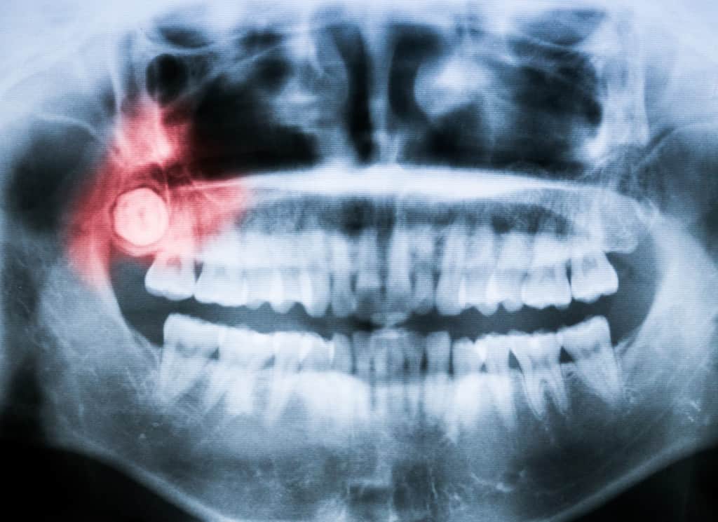 Not known Facts About Wisdom Teeth Removal Price