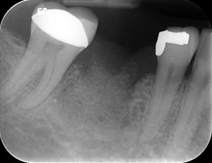 Tooth Removed, Bone Graft Added