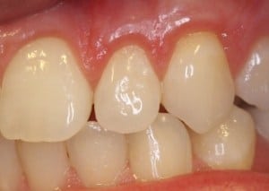 Teeth After the Gum Graft