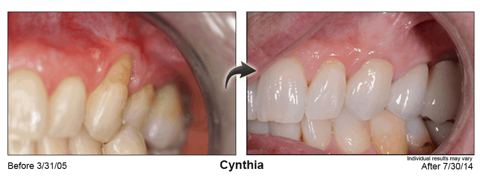 Before & After Pinhole Gum Rejuvenation Procedure