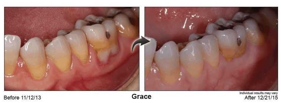 Receding Gums before & After Pinhole Gum Rejuvenation Procedure